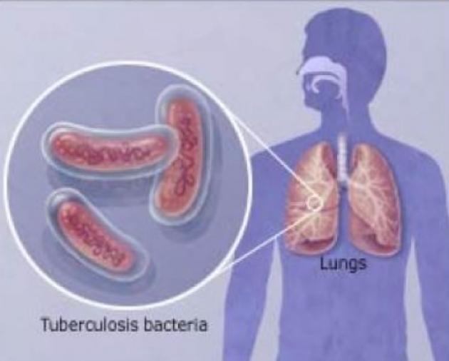 Dar kartą apie tuberkuliozę